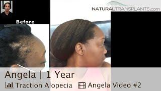 Hair Growth After Hair Transplantation Surgery for Traction Alopecia Cure | Dr. Blumenthal (Angela)