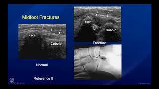 Sports Ultrasound of the Midfoot