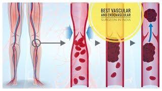 Top 10 Best Endovascular Surgeon in India | Top 10 Best Vascular Surgeon in India |