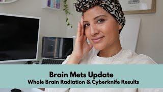 The Brain Mets Journey | Whole Brain Radiation and Cyberknife Results