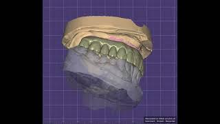 Upper Implant Crown bridge #design