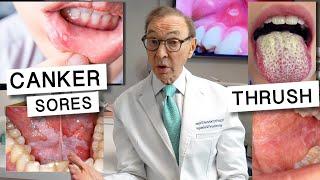 6 Causes of WHITE SPOTS in the Mouth | Home Treatment Options