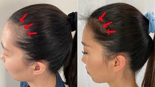 How I Fixed The Hairline? | iRestore Laser Hair Growth Therapy 4-Month Update | Chris Han