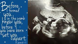 Pediatric Echocardiogram ll NICU update ll Trisomy 18 ?