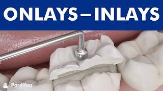 Dental inlays and onlays ©