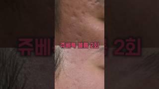 쥬베룩볼륨 여드름흉터 모공 주름  2회치료 놀라운효과 닥터지니시술 (  #도트필  #피코프락셀  )