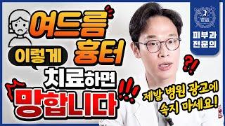 "돈 버리지 마세요" 수천만원 들여도 여드름흉터 치료 효과 없는 이유 | 시술별 효과 부작용 주의사항 | 프락셀 도트필 포텐자 미라젯