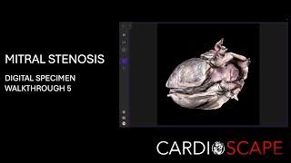 Digital walkthrough  5- Mitral stenosis | Cardiac Anatomy!