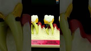 iDENTical Stages of Periodontitis Model - M4010 | Patient Education Tool #shorts #dental #viralvideo