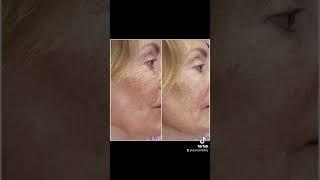 Arizona  Jet Plasma all natural face lift. Camp Verde Rimrock  #microneedle #fibroblast #plasmapen