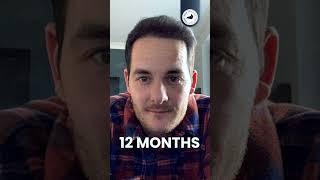 START YOUR TRANSFORMATION TODAY! - HAIR TRANSPLANT 12 MONTHS RESULT