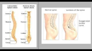 What is Lordosis: Hyperlordosis