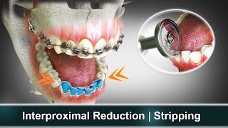 Interproximal Reduction (IPR) | Stripping | Orthodontic Treatment | Curveia Dental Animation