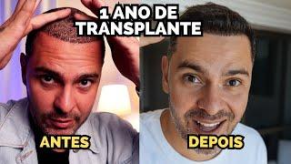 1 ANO DEPOIS DO MEU TRANSPLANTE CAPILAR  - PRINCIPAIS DÚVIDAS