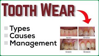 TOOTH WEAR - Types, Causes & Management