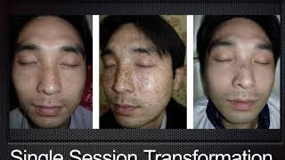 5 Reasons Why You Should Treat Pigmentation With Picolase Technology