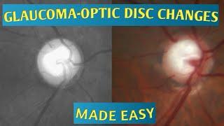 OPTIC DISC EVALUATION|CUP DISC RATIO| DEPTH OF CUP| BAYONETTING SIGN||LAMELLAR DOT SIGN| RNFL DEFECT