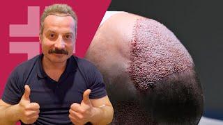 Hair Transplant in Turkey