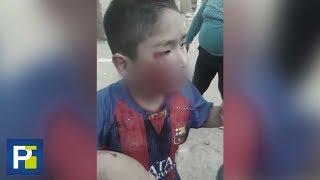 Con el rostro destrozado, así acabó un niño tras el ataque de un perro en Perú