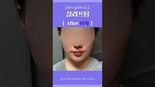 #shorts 실리프팅 효과 살펴보기! 피부 처짐 문제는 이것으로 해결!