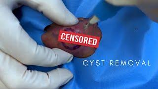 Dr. Timothy Jochen Handles A STUBBORN Cyst | CONTOUR DERMATOLOGY