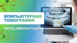   Компьютерная томография зубов перед имплантацией