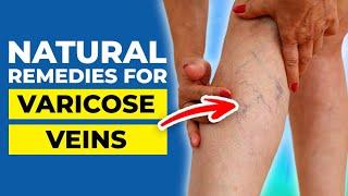 10 Natural Remedies for Varicose Veins