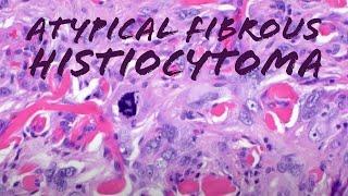 Atypical Fibrous Histiocytoma (atypical dermatofibroma): a mimic of sarcoma (pathology dermpath)