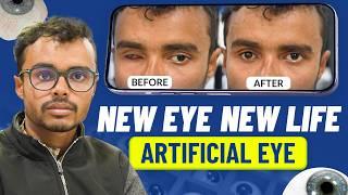 नयी आँख, नयी जिंदगी  | Artificial (Prosthetic) Eye which Moves & Looks like Natural Eye