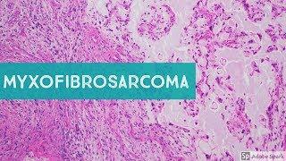 Myxofibrosarcoma 101...Explained by a Sarcoma Pathologist