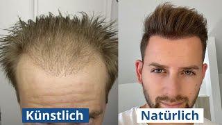 Haartransplantation: künstliche vs natürliche Haarlinie?! Woran erkennt man es?