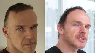 HAIR TRANSPLANT BEFORE AND AFTER