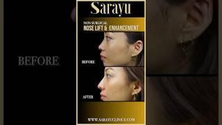 Bina Surgery Naak Lift Kaise Karein | Nose Lift Without Surgery | Dr Adarsh Tripathi -Sarayu Clinics