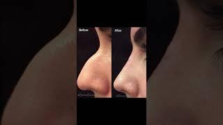 Non-Surgical Nose Job