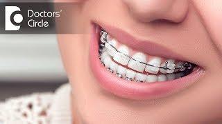 Is extraction of teeth necessary before going for Orthodontic Treatment ? - Dr. Nandini Nelivigi