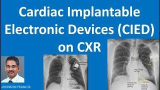 Cardiac Implantable Electronic Devices CIED on CXR