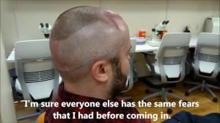 Patient IMMEDIATELY following an ARTAS robotic hair transplant talks about what it was like!