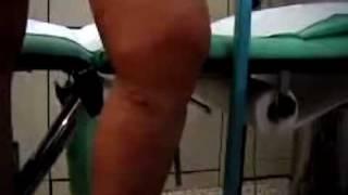 Trattamento di varici  recidive post stripping , vene varicose veneinforma