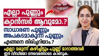 വായയിൽ പുണ്ണ് ഉള്ളവർ ഈ ഈ വീഡിയോ കാണുക| പുണ്ണ് ക്യാൻസർ ആവുന്നത് എപ്പോൾ? #വായ്പുണ്ണ്