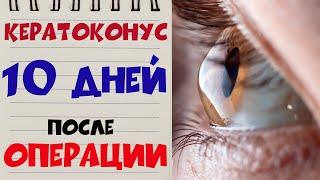  КЕРАТОКОНУС ‍️ Через 10 ДНЕЙ после операции на моих обоих глазах в Клинике Арцыбашева 