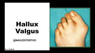 Hallux Valgus (bunion) w/ Dr. Tsai