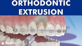 Orthodontic extrusion ©