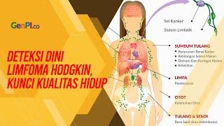 Pentingnya Deteksi Dini Limfoma Hodgkin untuk Kualitas Hidup Pasien