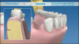 Восстановление дефекта кости с Lamina OsteoBiol