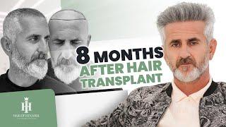 8 Months After Hair Transplant