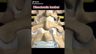 Disectomia lumbar, así operamos
