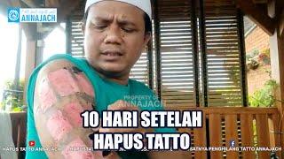 10 HARI SETELAH HAPUS TATTO