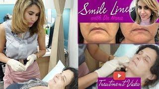 Mouth Wrinkles? How to Treat Marionette Lines with Dermal Filler