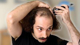 BALDING MAN Shaves Head Totally BALD & Looks AMAZING!