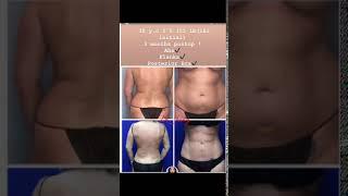 Before and after | Liposuction Before and after surgery | Top plastic surgeon Dr Jeneby